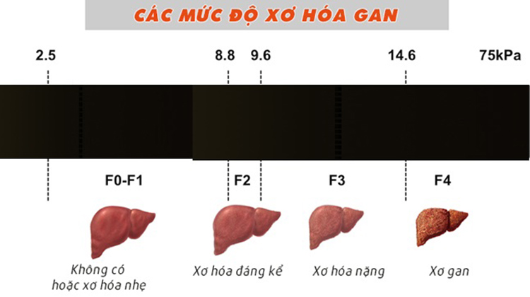 Xơ gan độ 3 là gì? 1