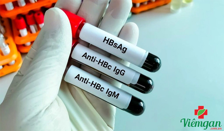 Xét nghiệm Anti Hbc 1